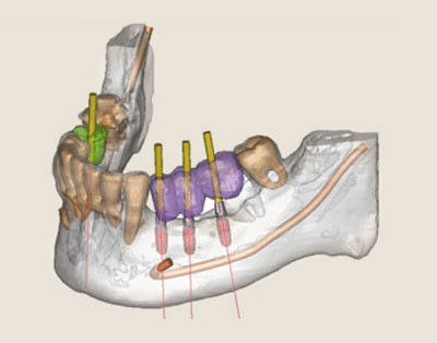 3D-Implantologie Minden| Navigierte Implantologie