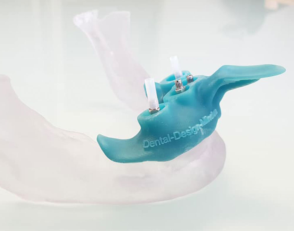 3D-Implantologie Minden| Foto: Dental-Design-Minden